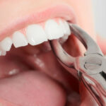 Как выполняется удаление зубов?