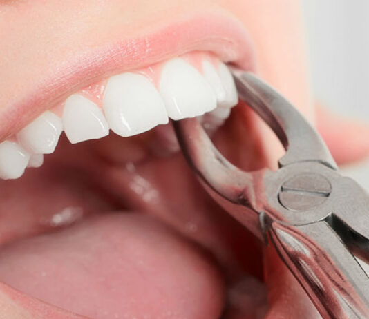 Как выполняется удаление зубов?