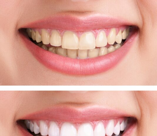 Отбеливание зубов: Методы, Достоинства и Риски