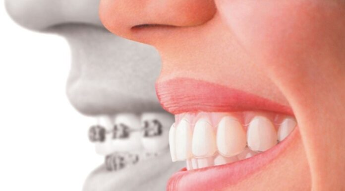 Что подразумевает собой ортодонтическое лечение?