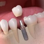 Почему стоит установить металлокерамическую коронку?