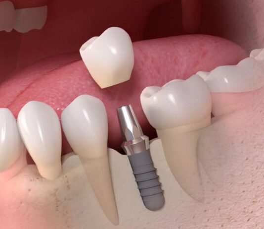 Почему стоит установить металлокерамическую коронку?