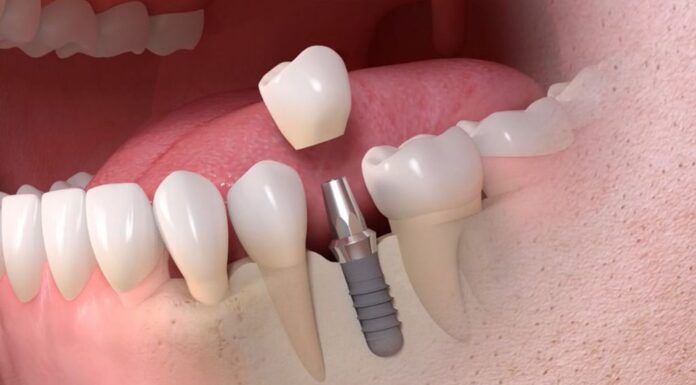 Почему стоит установить металлокерамическую коронку?