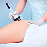 Особенности процедуры радиолифтинга бедер и ягодиц