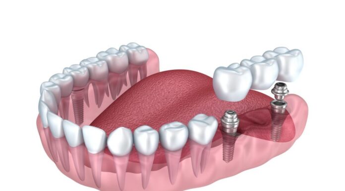 Как выполняется протезирование?