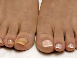 Можно ли идти к подологу с грибком ногтей