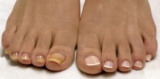 Можно ли идти к подологу с грибком ногтей