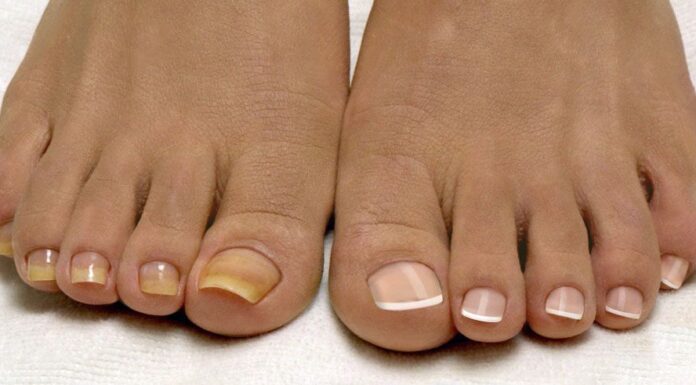 Можно ли идти к подологу с грибком ногтей