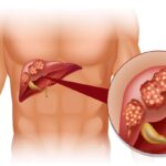 Почему возникает фиброз печени?