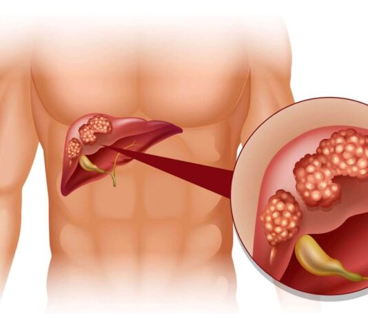 Почему возникает фиброз печени?