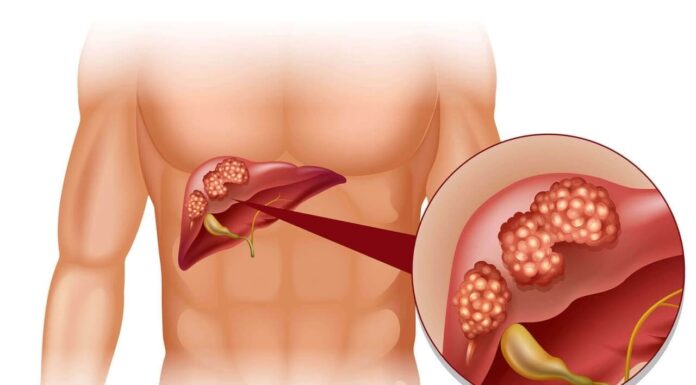 Почему возникает фиброз печени?