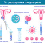 Кому показана процедура ЭКО?