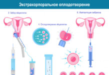 Кому показана процедура ЭКО?