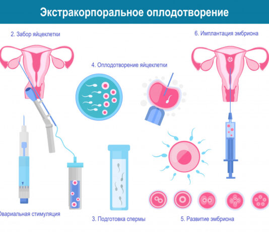 Кому показана процедура ЭКО?