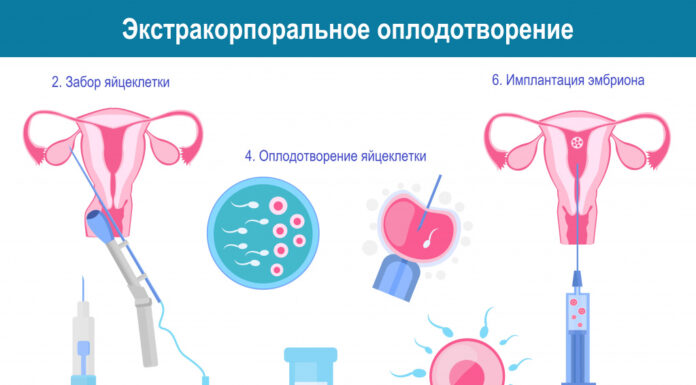 Кому показана процедура ЭКО?