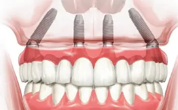 Что такое система All-on-4