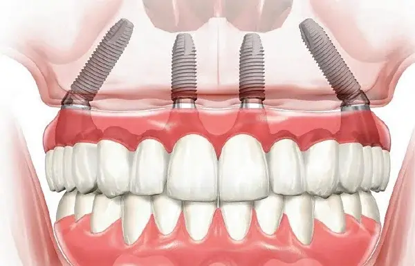 Что такое система All-on-4