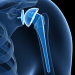 Что подразумевает собой эндопротезирование плечевого сустава