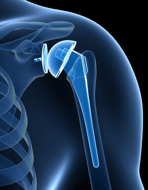 Что подразумевает собой эндопротезирование плечевого сустава