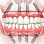 Имплантация All-on-4: плюсы и минусы