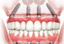 Имплантация All-on-4: плюсы и минусы