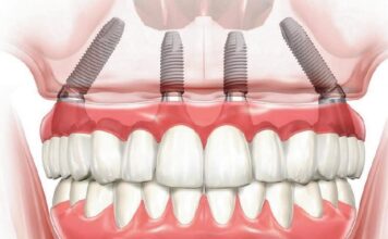 Имплантация All-on-4: плюсы и минусы