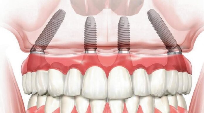 Имплантация All-on-4: плюсы и минусы