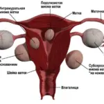 Этапы лечения миомы матки