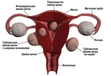 Этапы лечения миомы матки