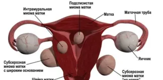 Этапы лечения миомы матки