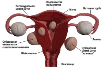Этапы лечения миомы матки