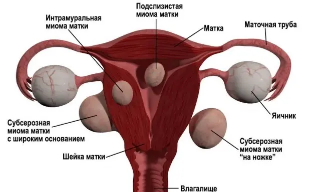 Этапы лечения миомы матки