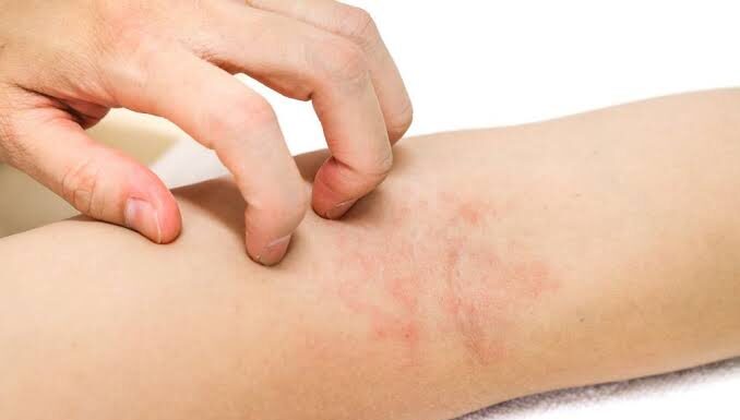 Дерматит: виды, причины и способы лечения